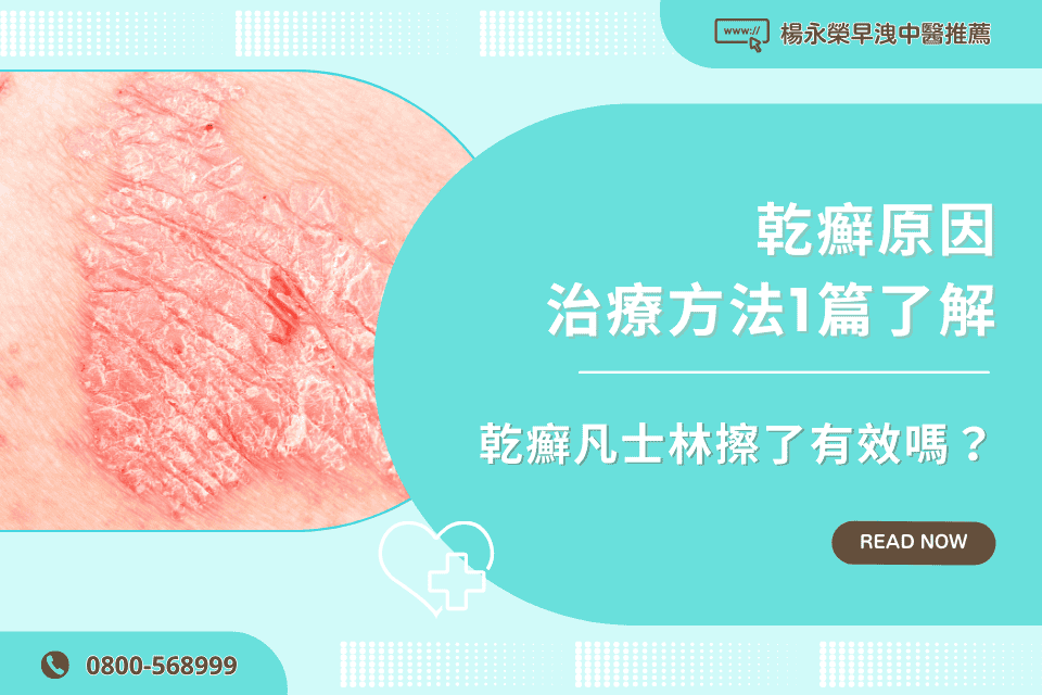 乾癬凡士林擦了有效嗎？乾癬原因、治療方法1篇了解